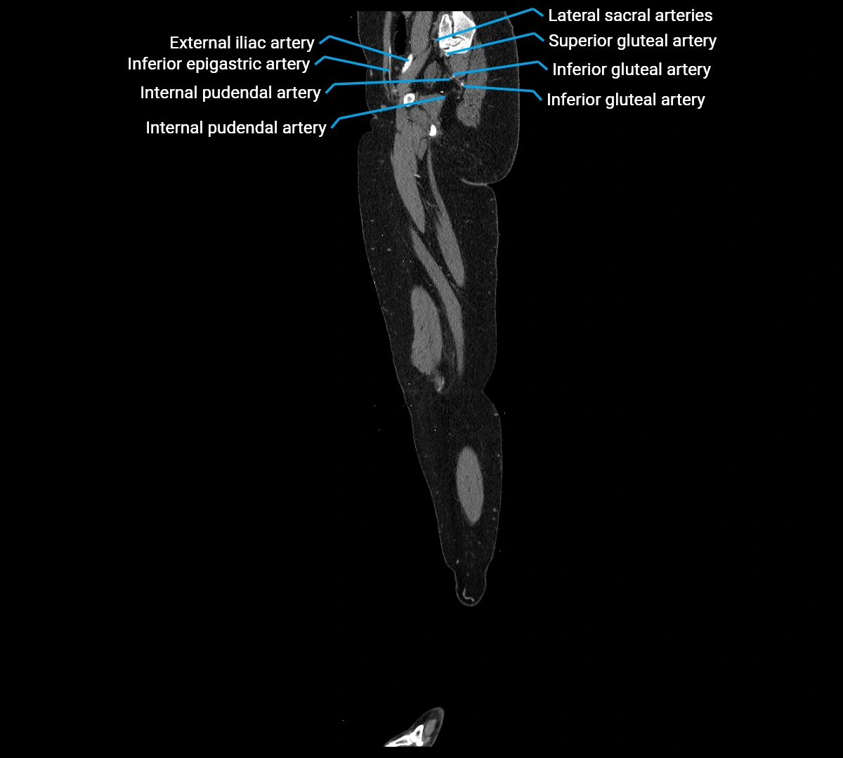CTA lower limb sagittal cross sectional anatomy labelled image _19 (3).webp